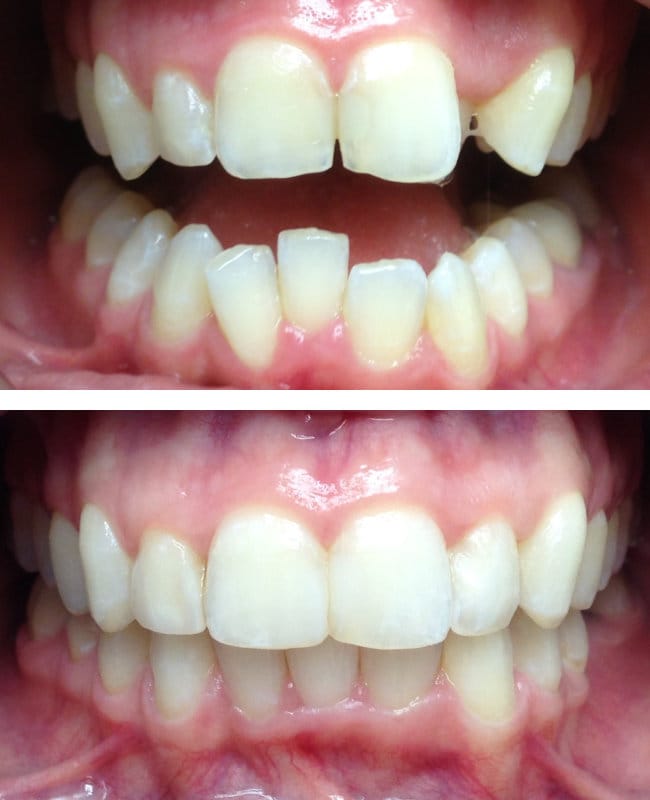 invisalign teeth case before and after