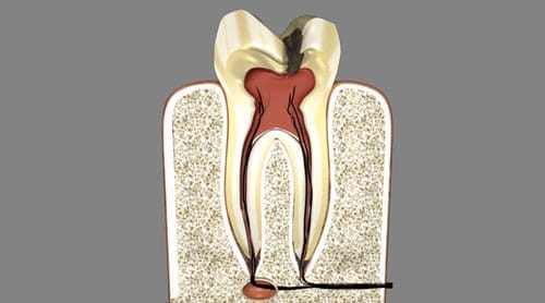 Picture of the root of a tooth